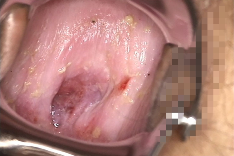 萎缩性阴道炎图 萎缩性阴道炎图