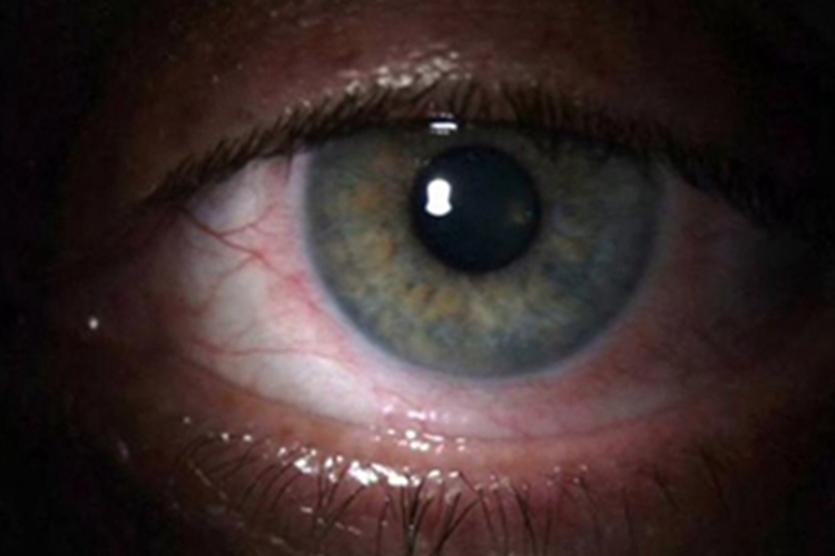 青光眼睫状体炎综合征角膜血丝图 青光眼睫状体炎综合征角膜血丝图