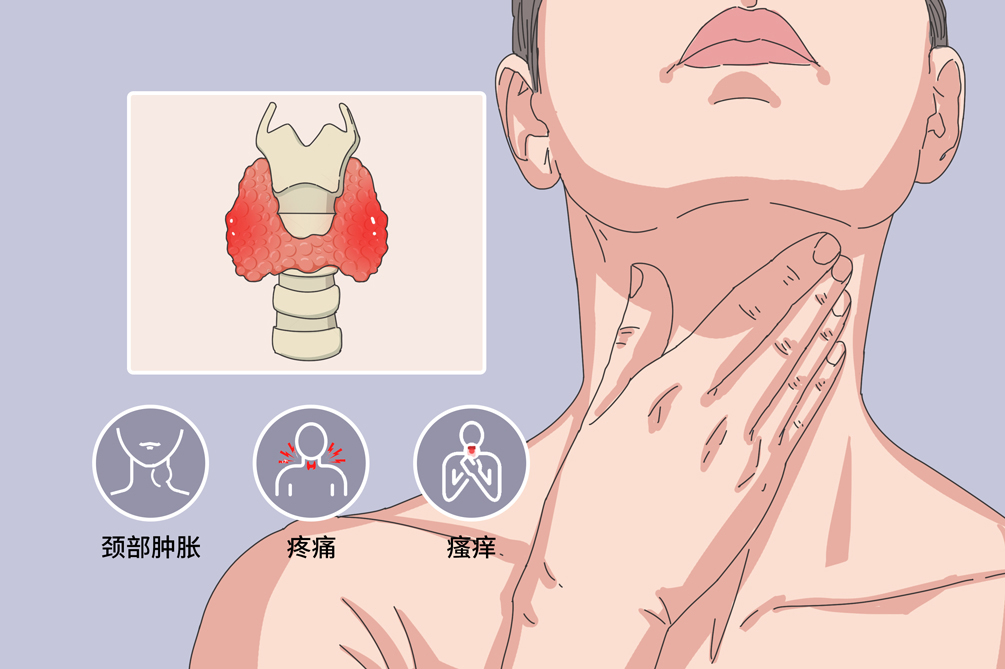 急性放射性甲状腺炎