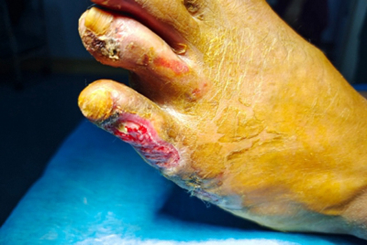 电烧伤脚趾焦痂图 电烧伤脚趾焦痂图