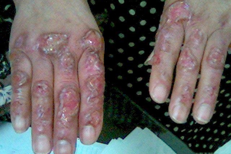 瘤型麻风手背溃疡图 瘤型麻风手背溃疡图