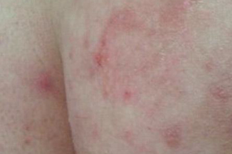 股癣臀部长很多红斑图