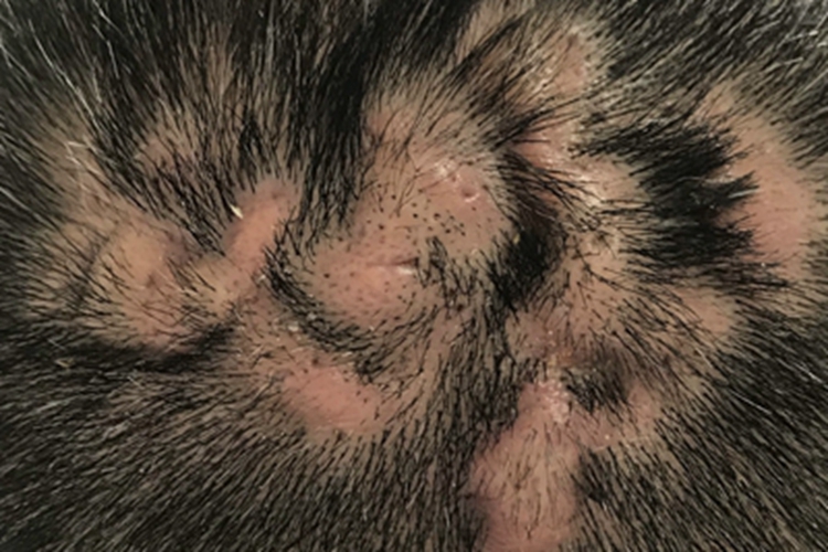 秃发性毛囊炎头皮瘢痕图 秃发性毛囊炎头皮瘢痕图