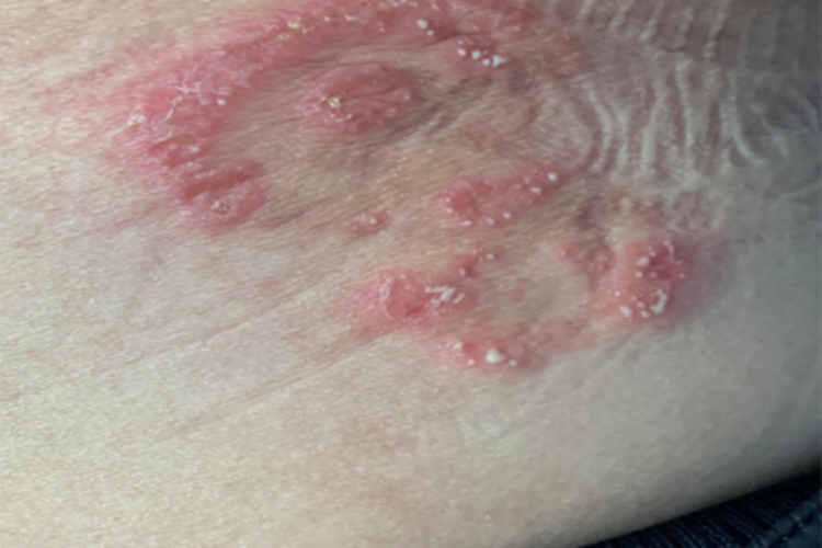 昆虫性皮炎腹部红斑图