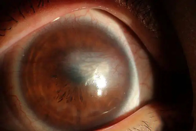 角膜白斑眼球发白图