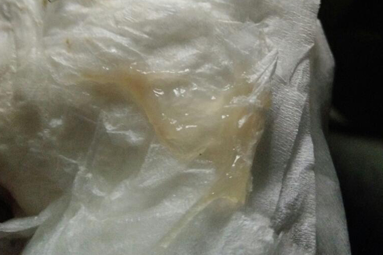 37周宫颈黏液栓带血图 37周宫颈黏液栓带血图