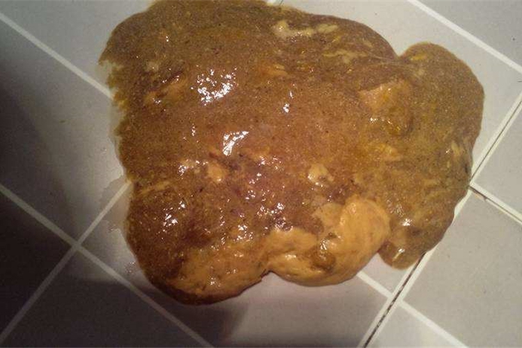 细菌性痢疾黏液脓血便图