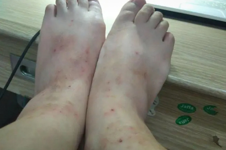 脚被虫子咬了图