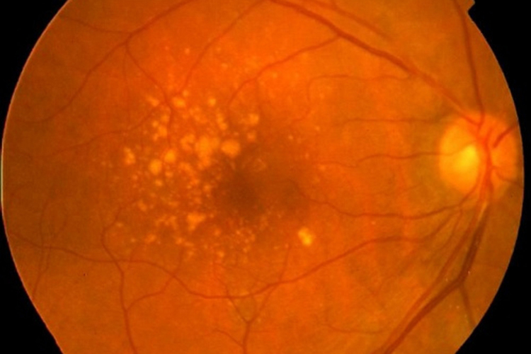 老年性黄斑变性图