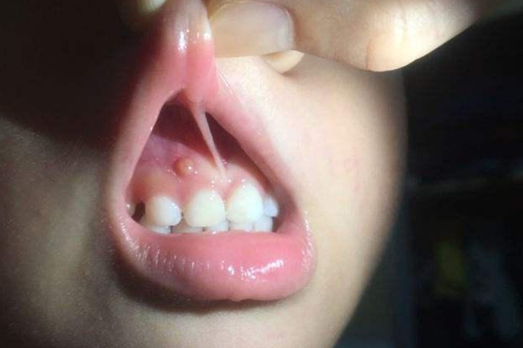 牙槽脓肿牙床鼓包图