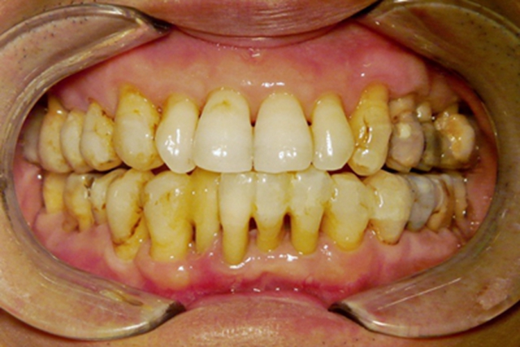 慢性牙周炎牙龈萎缩图 慢性牙周炎牙龈萎缩图