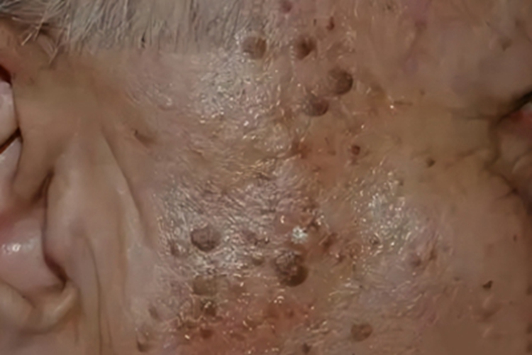 疣状脂溢性角化症面部症状图 疣状脂溢性角化症面部症状图