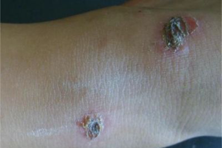 脓窝疮脚踝上有厚痂图