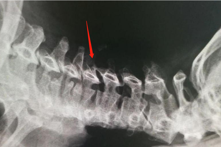 神经根型颈椎病X线图