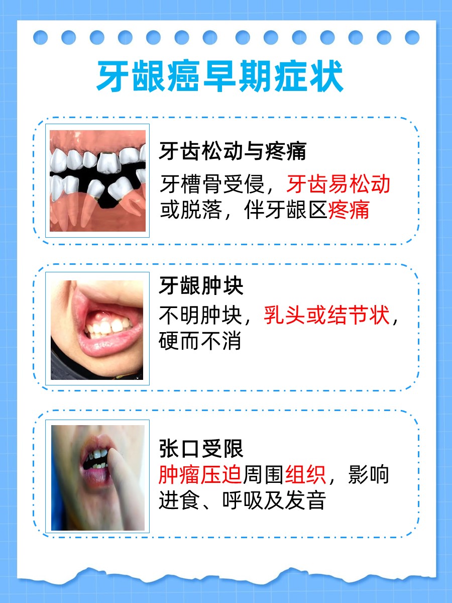 牙龈癌早期清晰图片