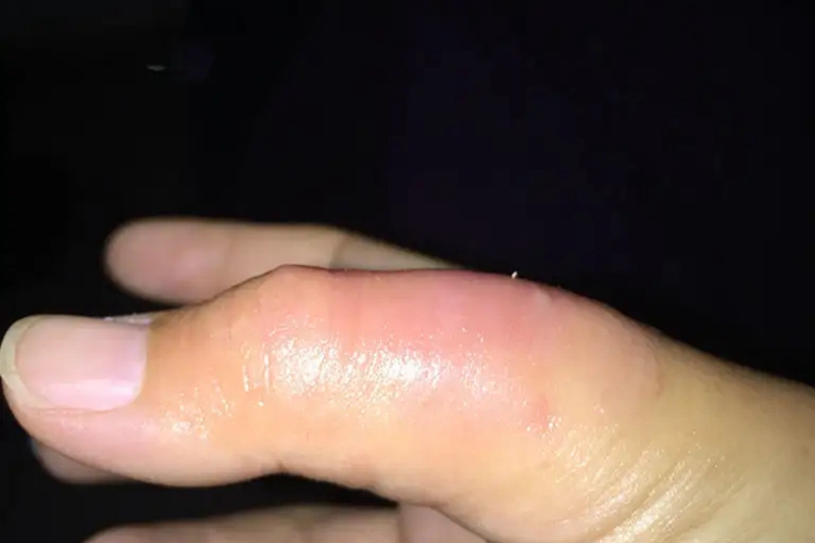 大拇指皮下血肿图