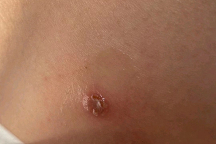 脓疱病腰部水疱图