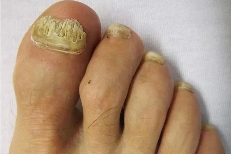 全甲毁损型灰指甲图