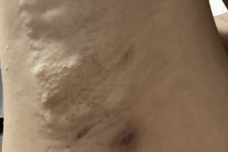 腋下皮脂腺囊肿图