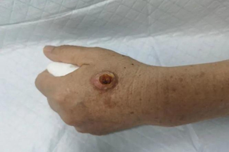 皮肤鳞状细胞癌圆疙瘩图