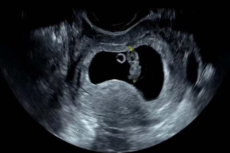 孕8周胎儿影像学图 孕8周胎儿影像学图