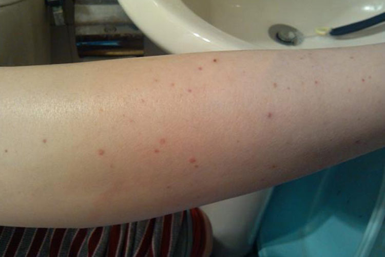 轻微过敏性紫癜初期症状图