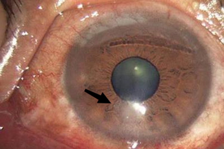 角膜溃疡白点图 角膜溃疡白点图