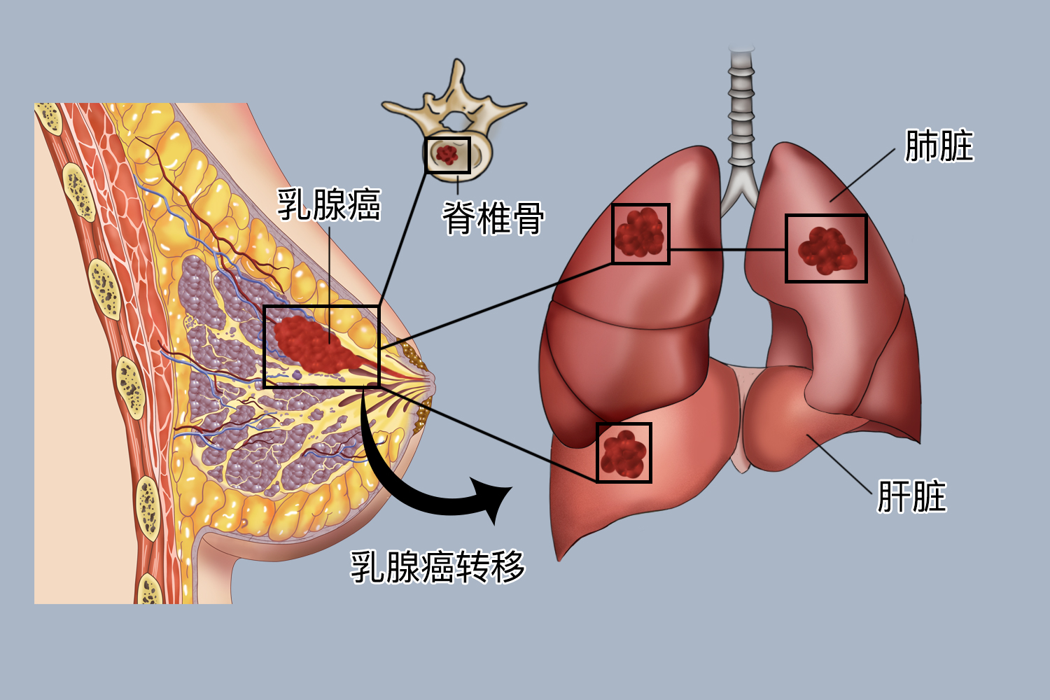 乳腺癌容易转移部位图