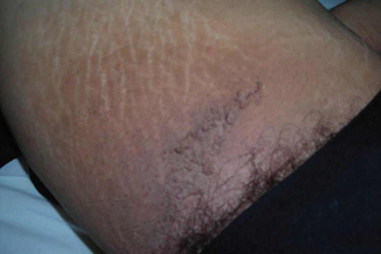 黑棘皮病大腿纹图