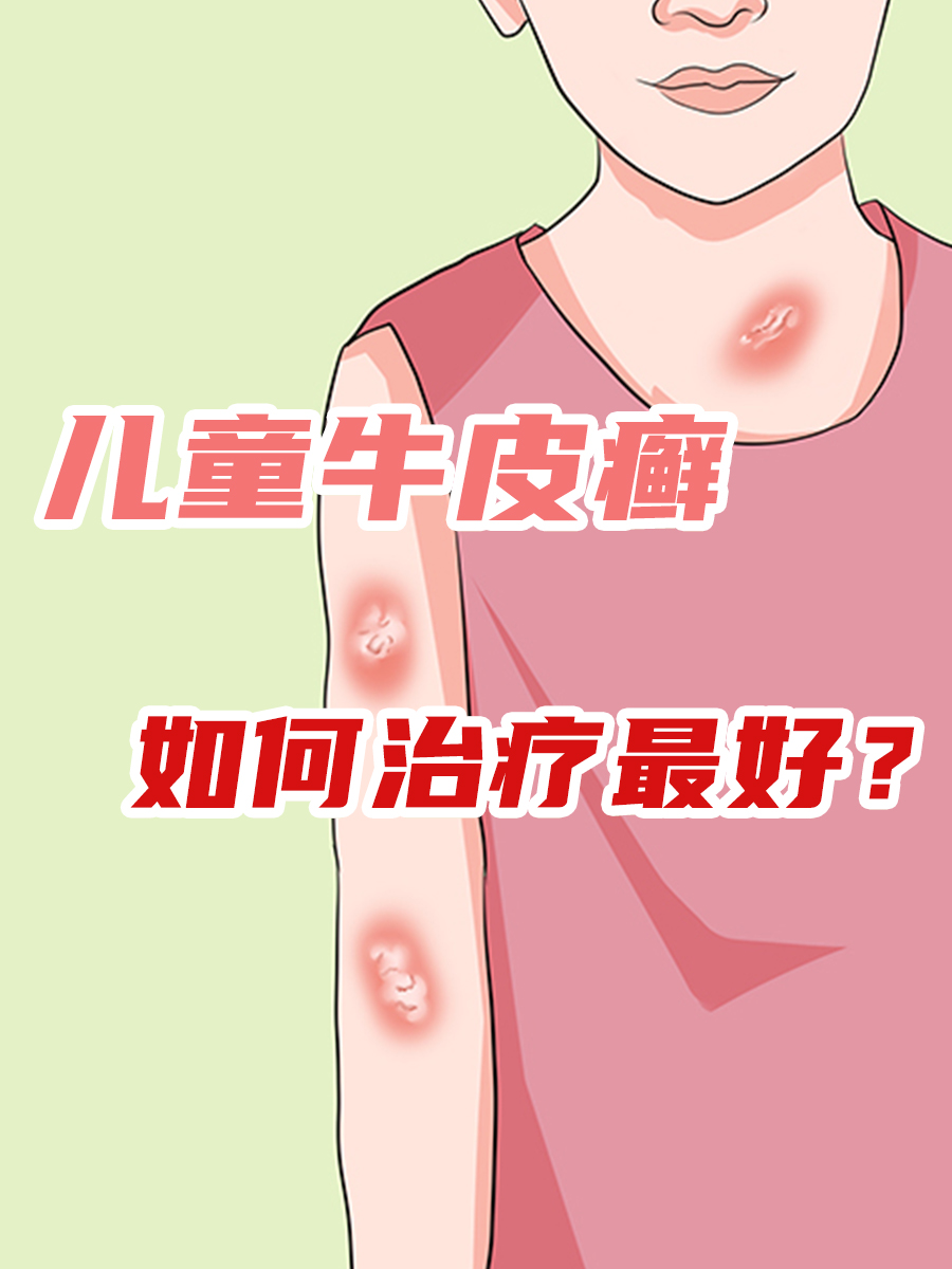 儿童牛皮癣最好治疗方法,少走弯路不踩坑!