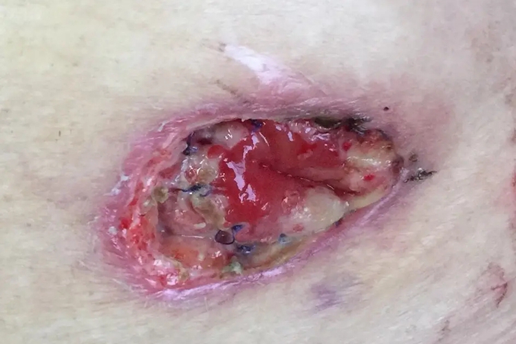 肠造口少量出血图 肠造口少量出血图