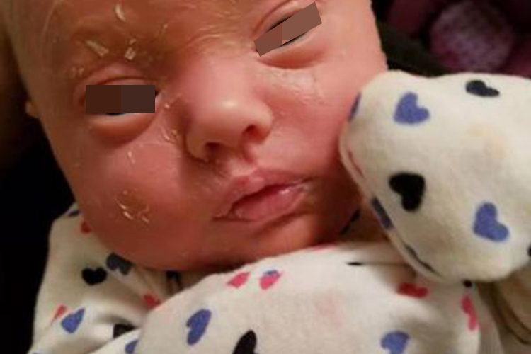 儿板层状鱼鳞病图 儿板层状鱼鳞病图