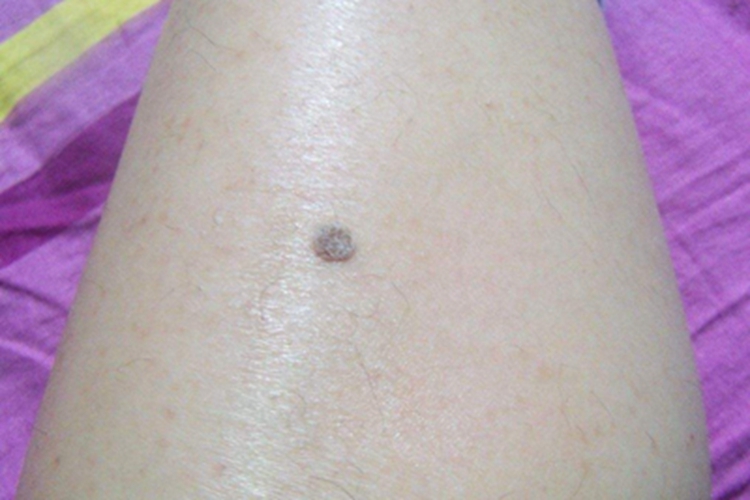 复合痣大腿黑痣图