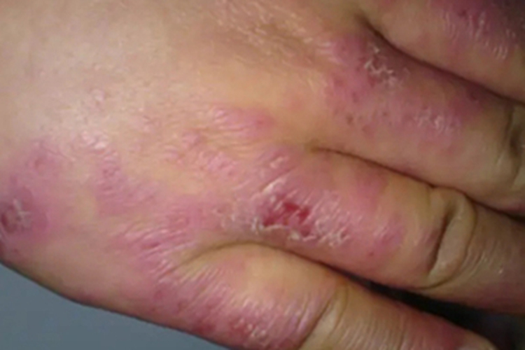 特发性网状青斑症状图