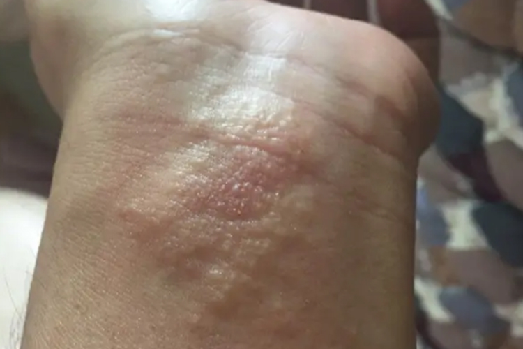 手腕汗疱疹症状图