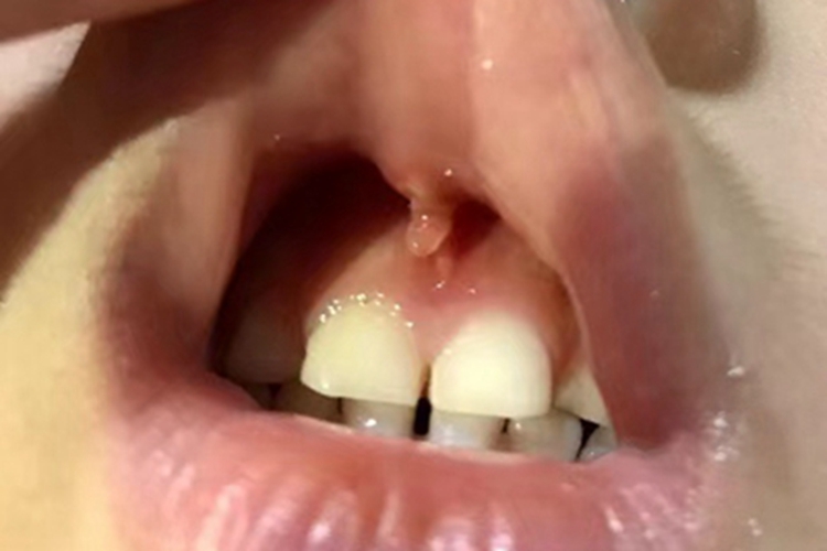 唇系带断裂症状图 唇系带断裂症状图