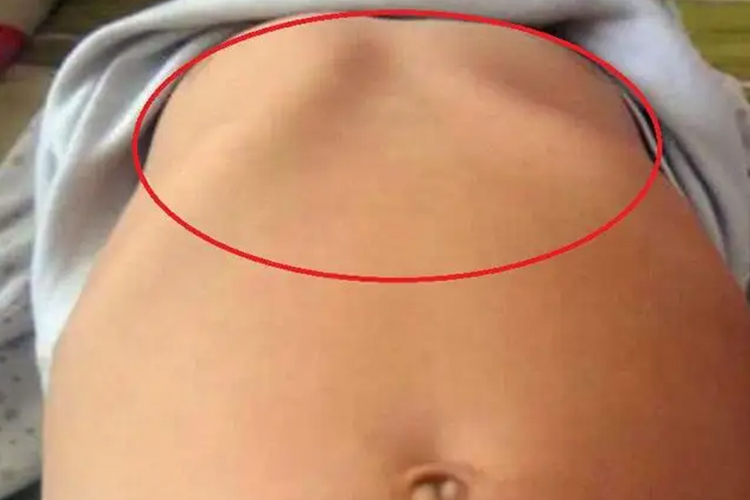 13岁儿童鸡胸症状图