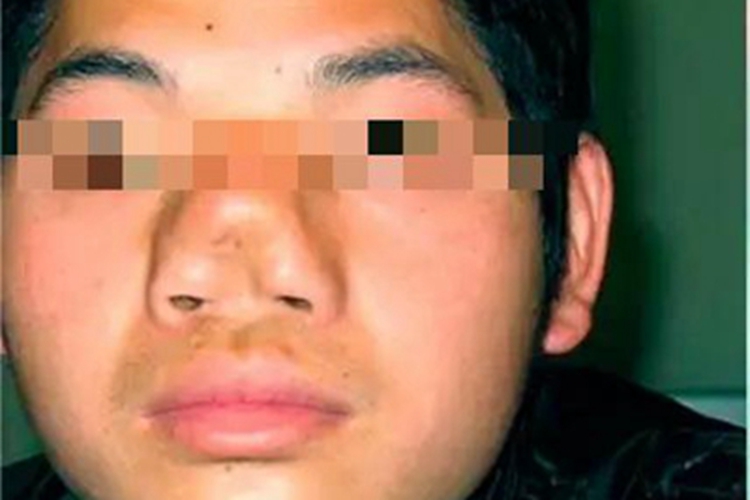 先天性鼻正中裂鼻尖症状图