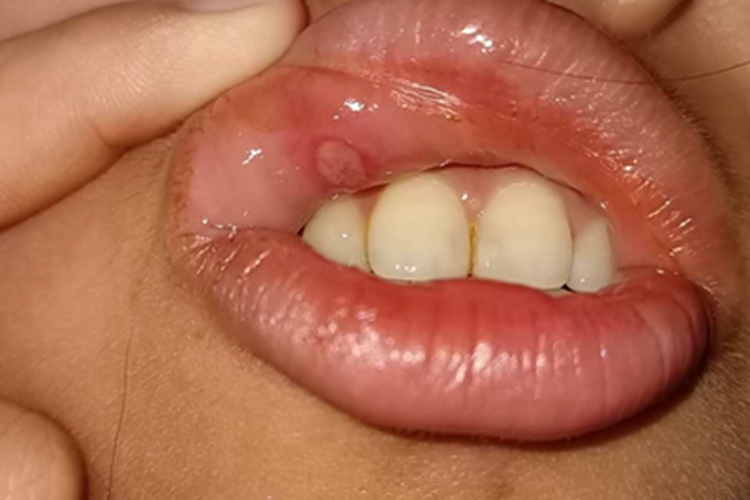 口腔溃疡唇内侧长白斑图