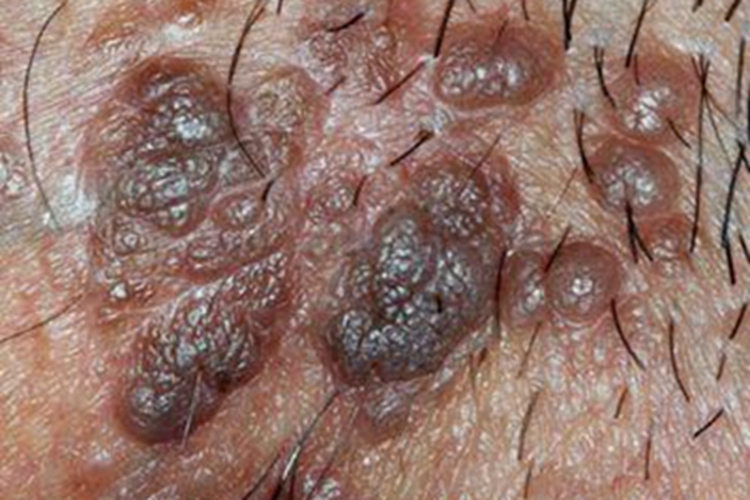 鲍恩样丘疹病会阴部疙瘩图