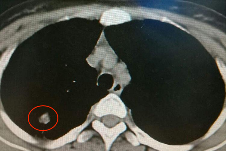 结核球CT影像学表现图 结核球CT影像学表现图