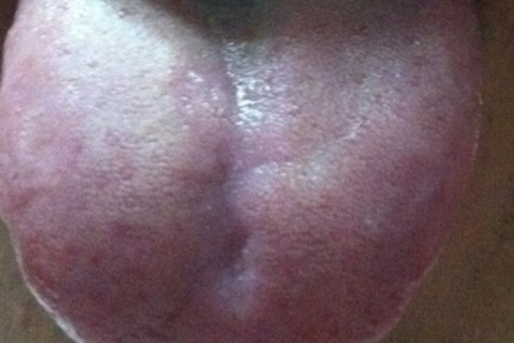 胃络瘀阻型慢性胃炎舌苔图 胃络瘀阻型慢性胃炎舌苔图