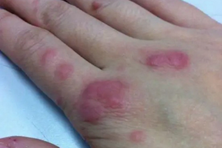皮肤型组织胞浆菌病手背疙瘩图 皮肤型组织胞浆菌病手背疙瘩图
