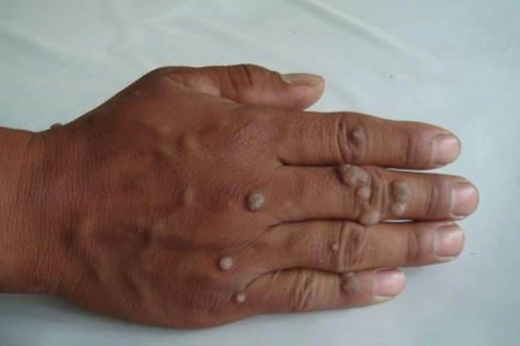 手上尖锐湿疣图 手上尖锐湿疣图