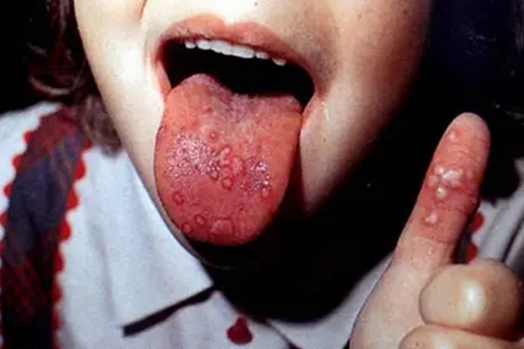 手足口病口腔疱疹图