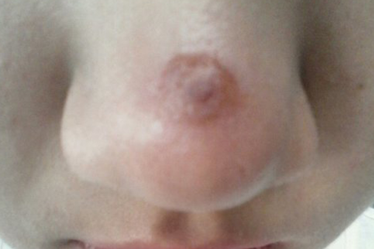 鼻子有灰褐色纤维瘤图 鼻子有灰褐色纤维瘤图