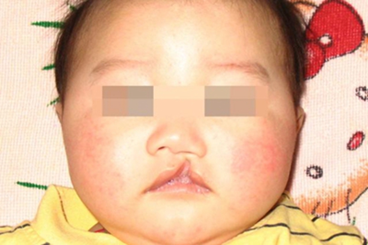 Ⅱ度唇裂嘴唇症状图