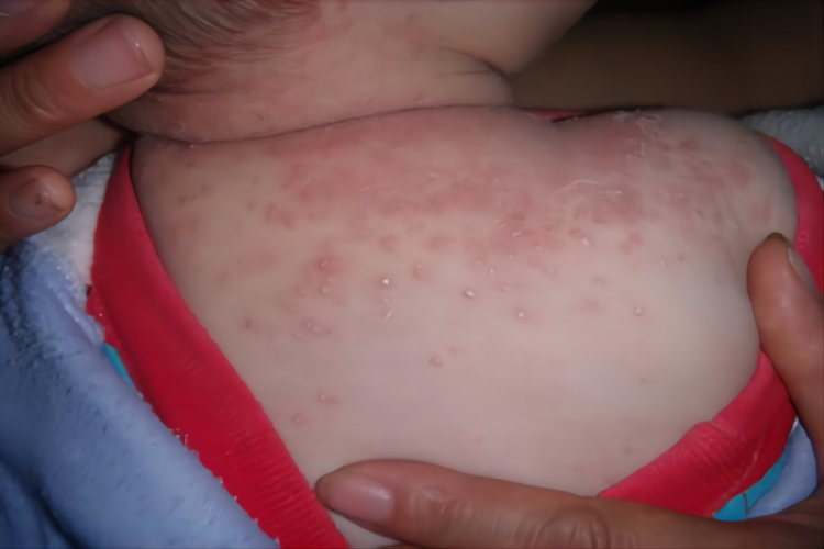 儿童脖子湿疹图