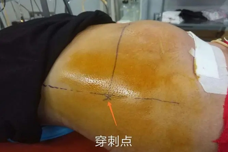 腹腔闭式引流穿刺位置图