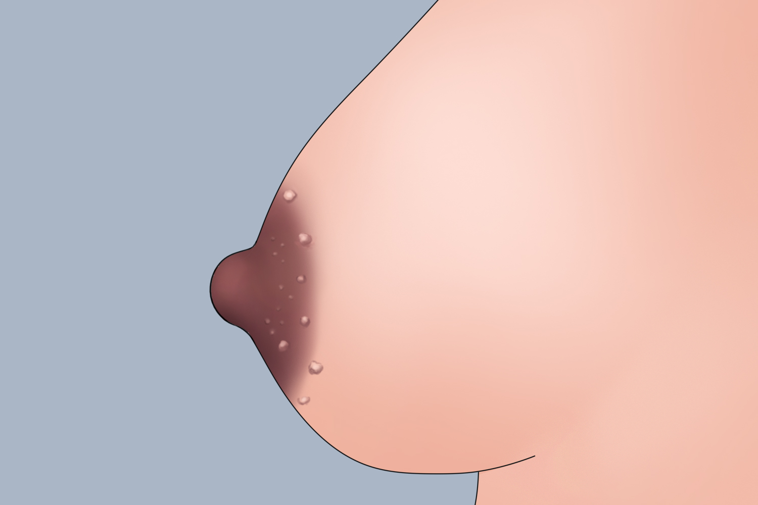 怀孕中期乳头增大有蒙氏结节图